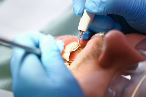 Best Emergency Dentist for Lost Fillings or Crowns in Bridgeport, NY